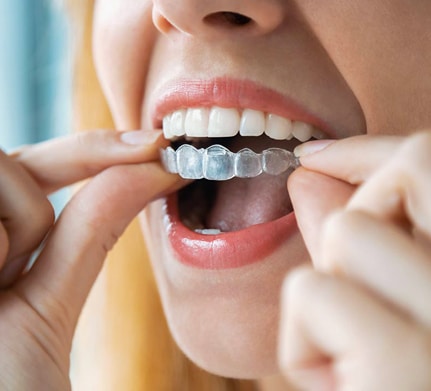 Person inserting clear orthodontic aligner into mouth for teeth straightening treatment.