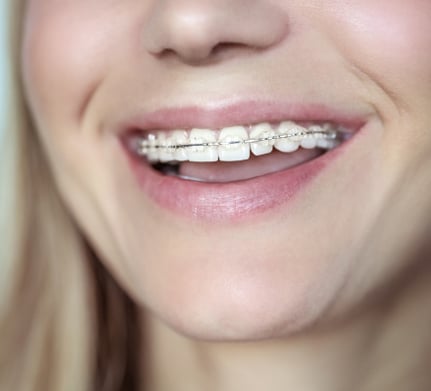 Close-up of smiling person wearing metal braces on upper and lower teeth