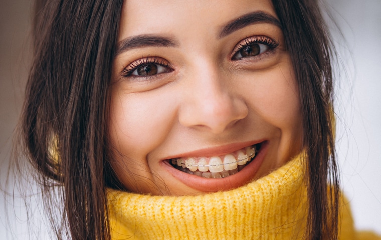 clear-ceramic-braces
