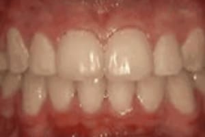 Healthy white teeth aligned in upper and lower rows against pink gum tissue.