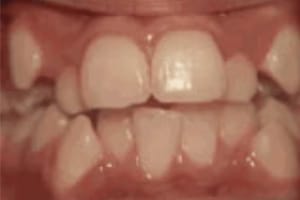 Close-up view of upper and lower teeth showing dental alignment and bite relationship during orthodontic assessment.