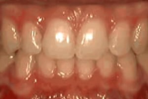 Upper front teeth showing orthodontic treatment progress with visible brackets and wires on dental model.