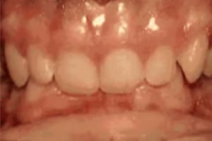 Close-up intraoral view of upper and lower teeth showing dental alignment and bite relationship.