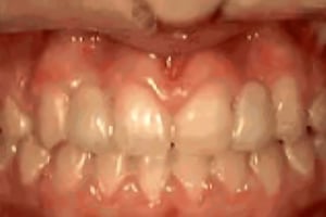 Close-up view of teeth showing orthodontic alignment and bite correction treatment progress.