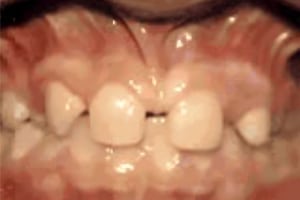 Close-up view of upper front teeth showing orthodontic treatment with ceramic braces and brackets.