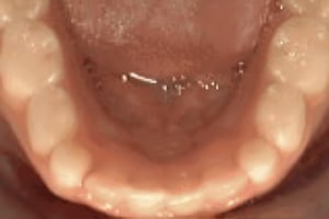 Close-up intraoral view of lower teeth and gums showing dental alignment assessment.