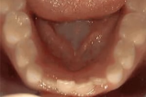 Close-up intraoral view of open mouth showing lower teeth and tongue for orthodontic examination.