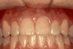 Close-up frontal view of aligned upper and lower teeth showing orthodontic treatment results.