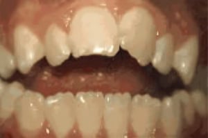 Dental close-up showing upper and lower teeth with slight gap between front incisors.