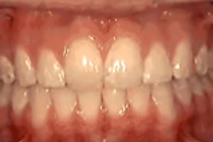 Close-up view of aligned upper and lower teeth showing orthodontic treatment results with healthy gums.