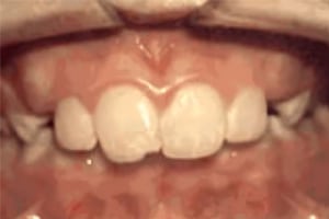 Close-up of upper front teeth showing dental alignment and whiteness, orthodontic example.