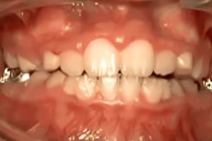 Dental braces on upper and lower teeth showing orthodontic treatment progress with metal brackets and wires.