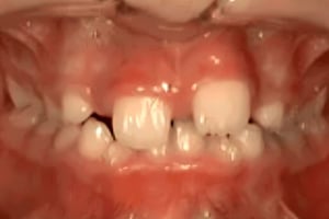 Close-up of child's upper front teeth showing severe crowding and misalignment requiring orthodontic treatment.