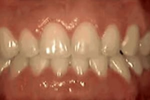Close-up of upper front teeth showing dental alignment before orthodontic treatment.
