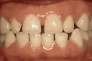 Close-up of upper and lower teeth showing orthodontic treatment with brackets and wires.