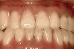 Close-up of aligned white teeth showing successful orthodontic treatment results in dental setting.