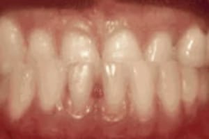 Straight, evenly-spaced white teeth displayed in close-up dental photograph showing orthodontic treatment results.