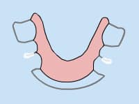Dental braces diagram showing pink upper arch with metal brackets on light blue background.
