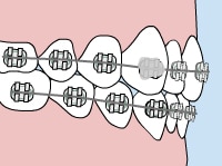 Orthodontic braces on teeth showing alignment correction between pink and blue backgrounds.