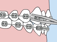 Orthodontic braces on teeth showing dental alignment treatment progression from misaligned to straight.