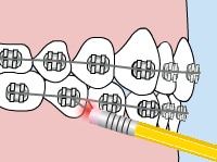 Orthodontic braces on teeth with yellow toothbrush demonstrating proper dental hygiene cleaning technique.